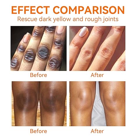 Lemon Dark Knuckle Remover Underarm Cream Dark Toe Knuckles Treatment Removal Remover Corrector for Armpit Knees Elbow Inner Thigh Neck Private Part Intimate Skin Cream 120g